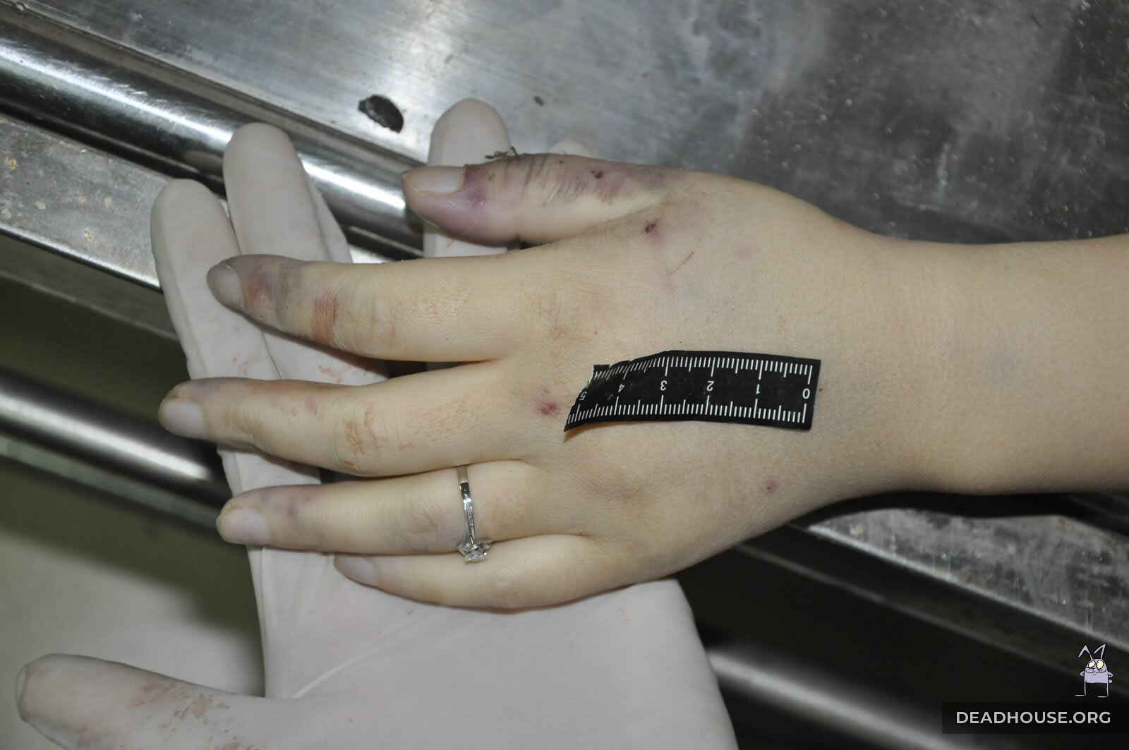 Кольцо на руке и характерные повреждения кистей рук