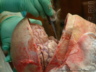 Аутопсия. Изъятие мозга из черепа