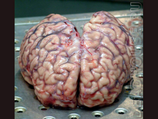 Аутопсия. Мозг
