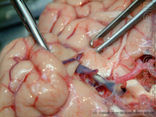 Аутопсия. Мозг и сосуды мозга